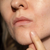 A woman with a small pimple on her face, seeking treatment for her skin condition