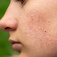 A woman with obvious acne lesions on her face seeking treatment for her skin condition