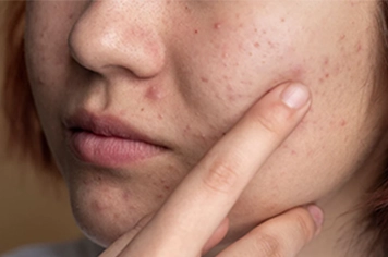 Find the best acne scar treatments to improve skin texture and achieve clear, radiant skin.