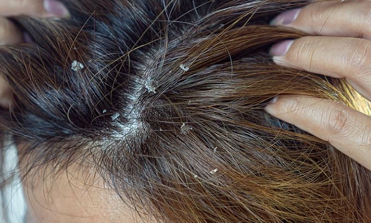 Regular hair washing helps remove dust and allergens, keeping your scalp clean and healthy.