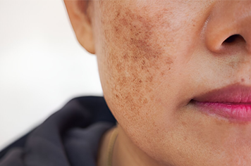 Advanced pigmentation treatment to reduce dark spots and achieve an even, radiant skin tone.