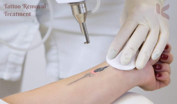 Professional tattoo removal services provide achievements that are both secure and reliable