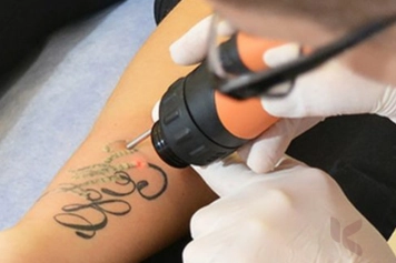 During  tattoo  removal treatment to removing a tattoo on one's arm shows that the picture