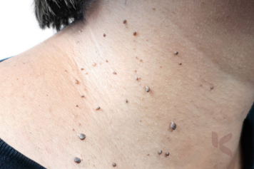 A woman receiving wart removal treatments has multiple little black dots around the neck area.