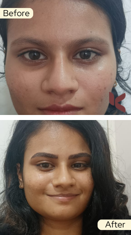 Testimonials of Before & After Skin Care Treatments, Coimbatore