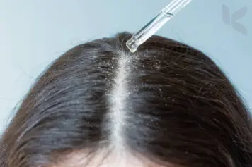 A woman receiving treatment for dandruff in a hospital to maintain a healthy scalp