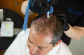 An advanced hair regrowth treatment for men who are trying to grow back their hair