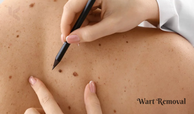 A dermatologist is applicable a wart removal medical care to someone's skin utilizing a tool.