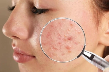 A woman intently inspects her skin with a magnifying lens to look for any anomalies or blemishes